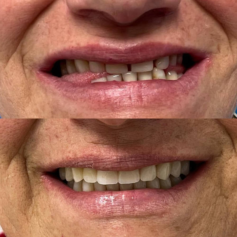 dentiera nuova, sorriso perfetto.